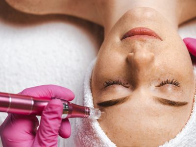 microneedling